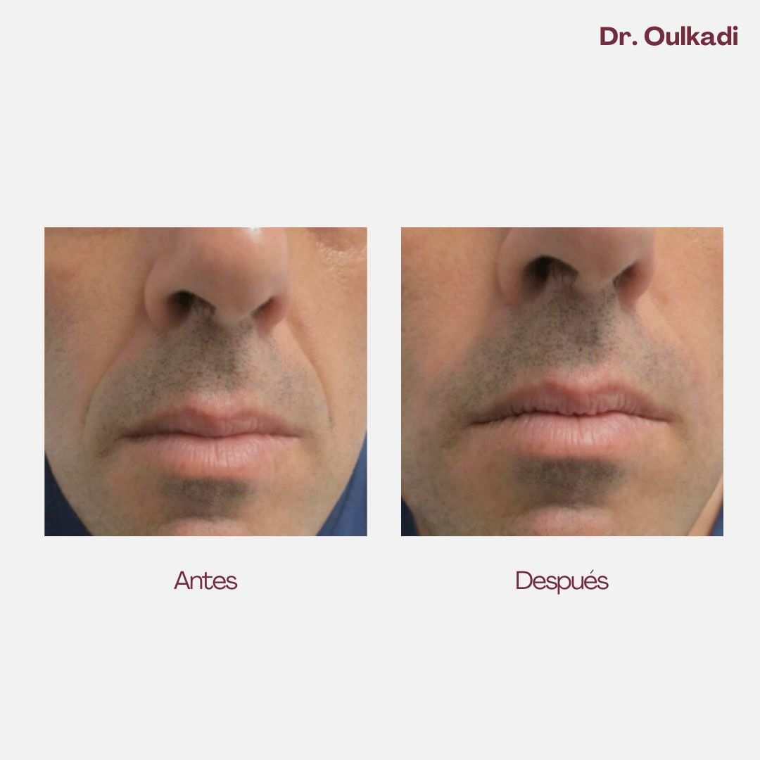 Antes y después — Relleno de surcos nasogenianos