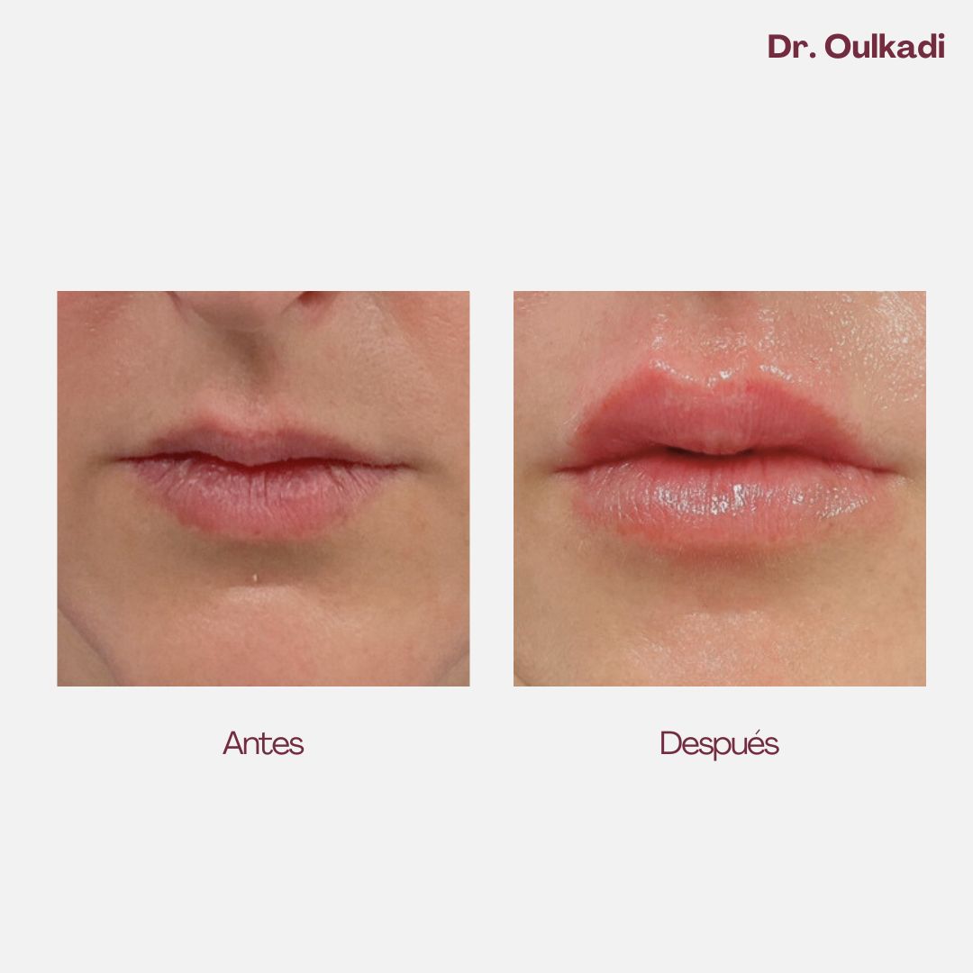 Antes y después — Relleno de labios natural