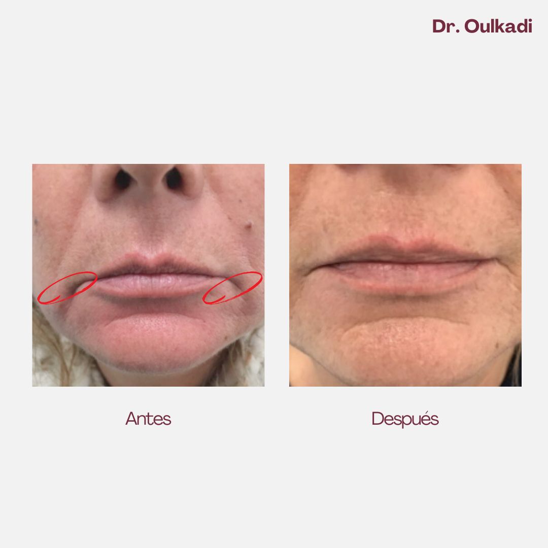 Antes y después — Corrección del rictus de marioneta