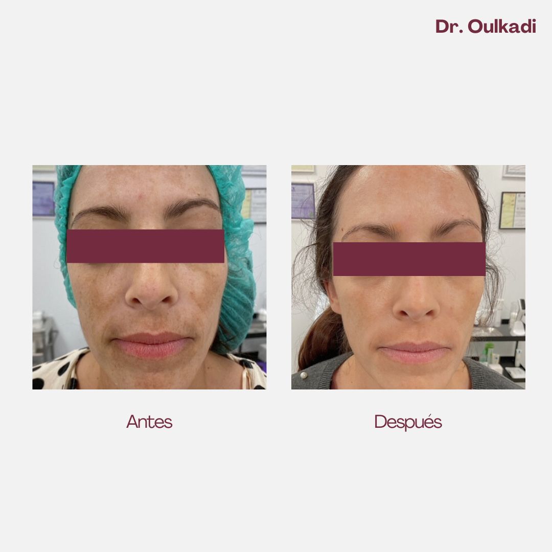 Antes y después — Tratamiento despigmentante facial